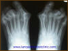 Radiograph of Rheumatoid Feet